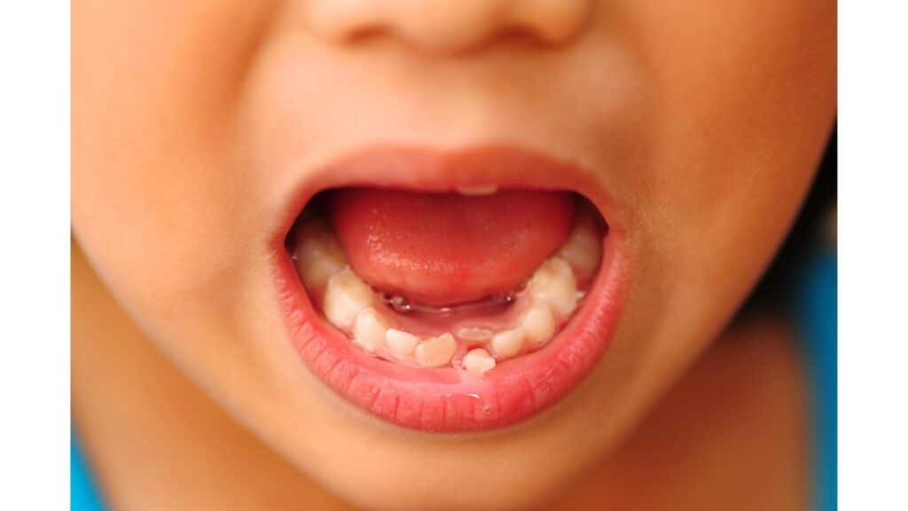 Can a loose baby tooth reattach itself