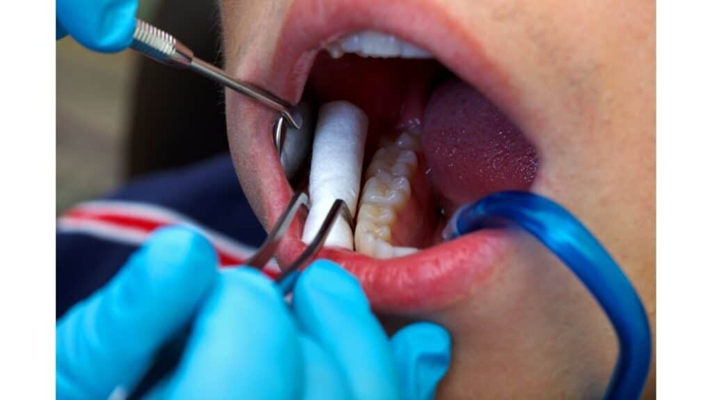 Dentist Checking Impacted Canine Teeth
