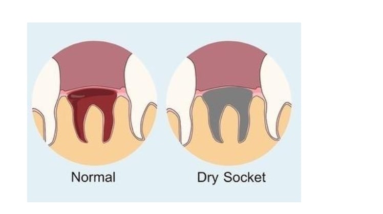 Dry Socket After Wisdom Tooth Removal