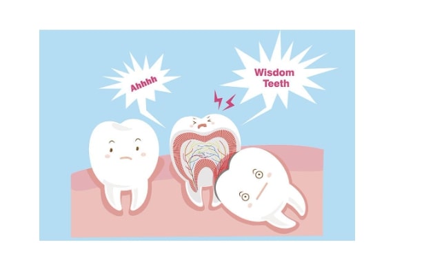 Removal of Wisdom Teeth