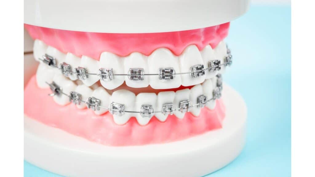 Dental Braces Model