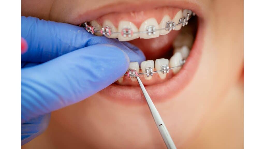 How to get braces glue off teeth